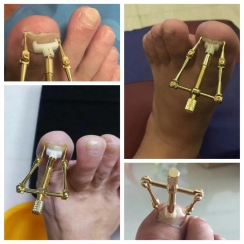 Nail Corrector
